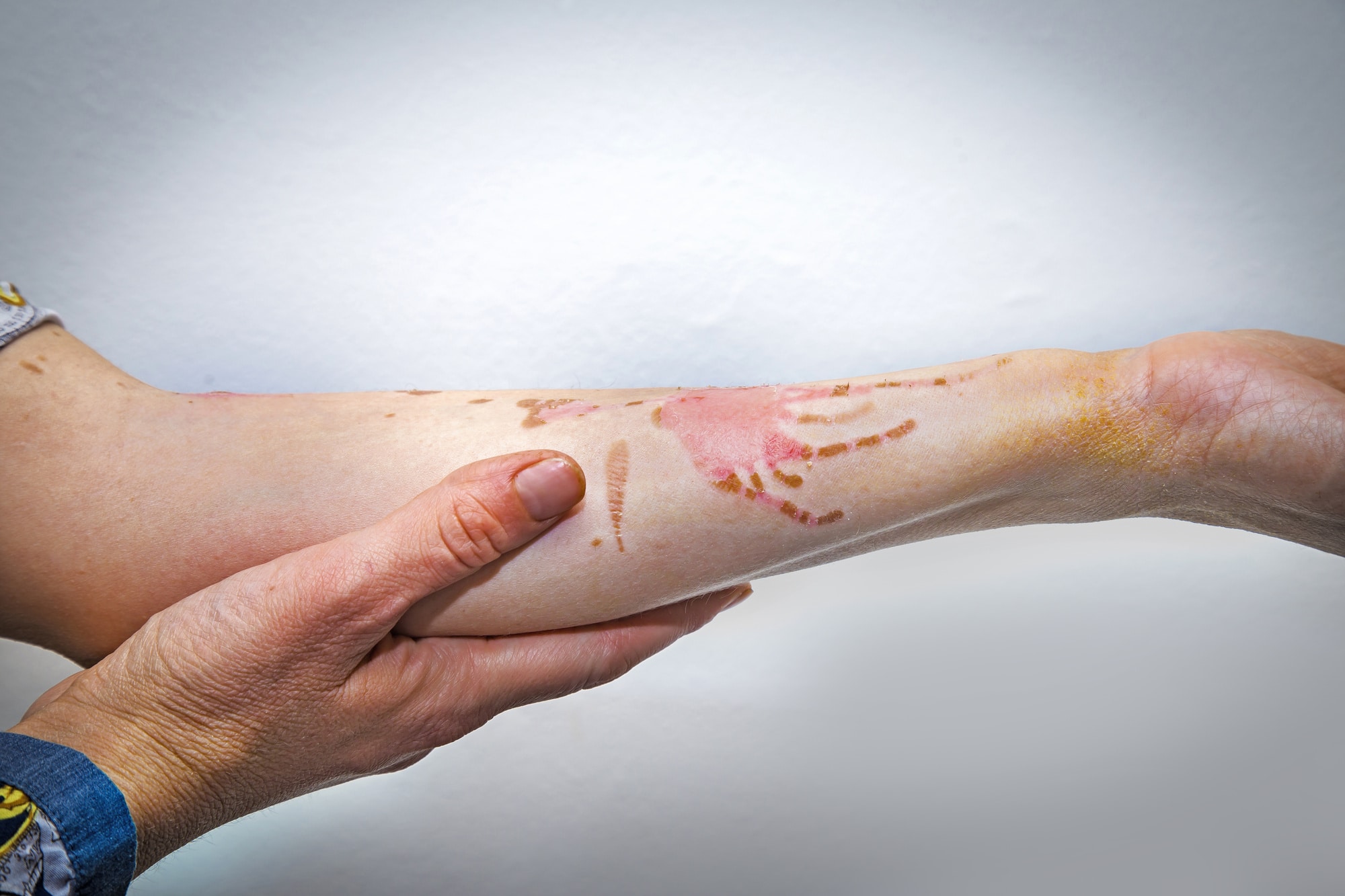 Does This Look Bad: 5 Signs of Infected Burn | Oxford Urgent Care