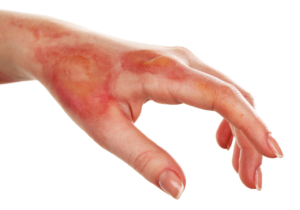 A burn on a woman's hand