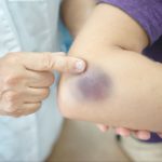 A closeup image of a doctor holding a patient’s arm in their hand while examining and pointing to a bruise near their elbow.