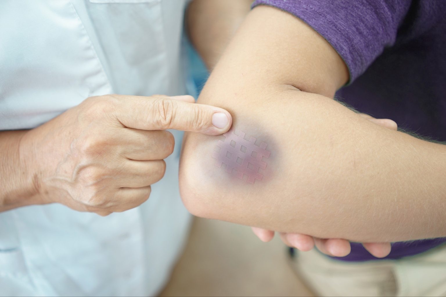 How to Treat a Bruise Oxford Urgent Care
