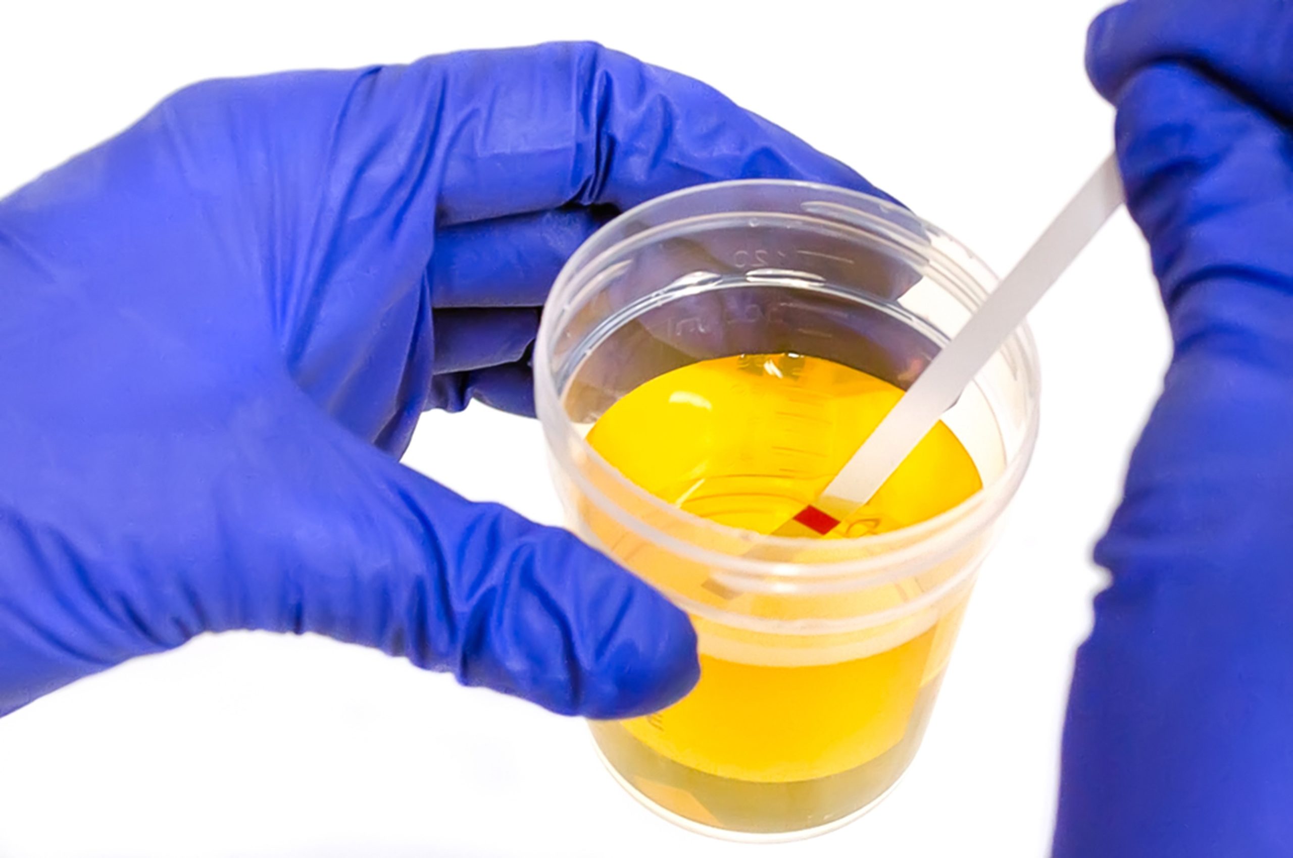 Gloved hands holding inserting a testing strip into a jarred urine sample.