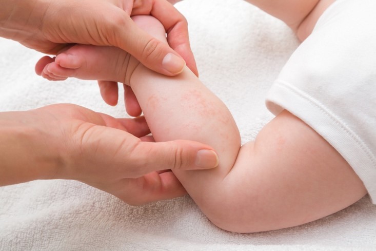 A closeup image of a woman holding a baby’s leg to examine a rash.