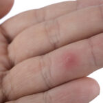 Close up of splinter in finger
