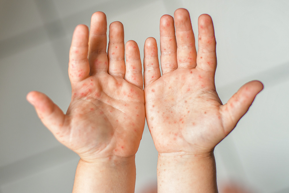 Hand foot and mouth disease rash on child's hands.